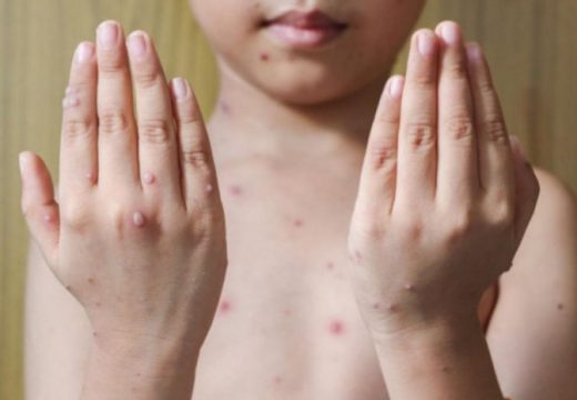 U 11 zemalja potvrđeno 80 slučajeva majmunskih boginja