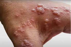 Sumnja na majmunske boginje u Prištini, uzorak na analizi