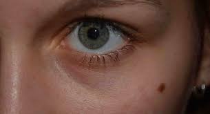 Šta znači mladež u blizini oka? U većini kultura ima isto značenje