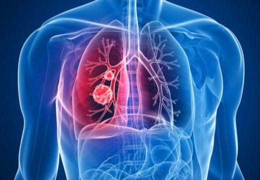 Ovo su 2 znaka da imate tromb u plućima