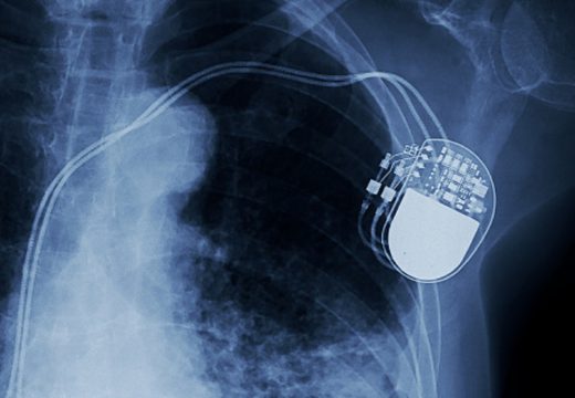 Istraga protiv pet ljekara zbog prodaje pejsmejkera s umrlih pacijenata