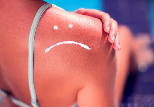 Kako spriječiti, a u posljednjem slučaju liječiti opekotine od sunca?
