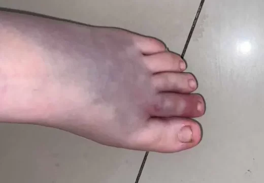 Djevojčicu ugrizao poskok kod Zvornika (Foto)