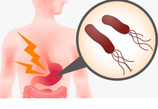 Deset najčešćih simptoma infekcije heliko bakterijom