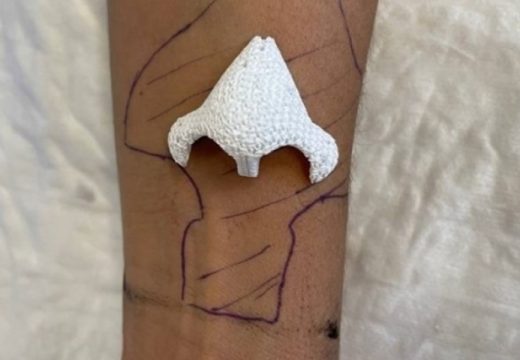 Hirurzi novi nos, zatim ga pričvrstili pacijentkinji na ruku