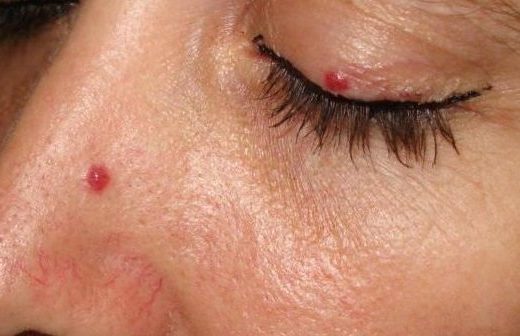 Na koži su vam se pojavili crveni madeži: Evo zbog čega nastaju i da li su opasni