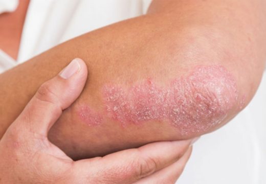 Obratite pažnju!: Ovi simptomi ukazuju na psorijazu kod djece