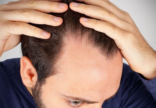 Ostvarenje sna mnogih muškaraca: Naučnici na pragu otkrića lijeka protiv ćelavosti