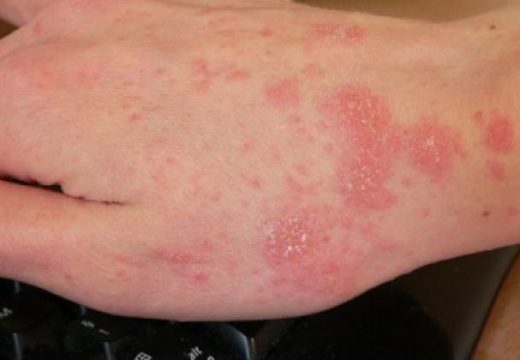 Nije epidemija: Šuga izbila u većini crnogorskih opština