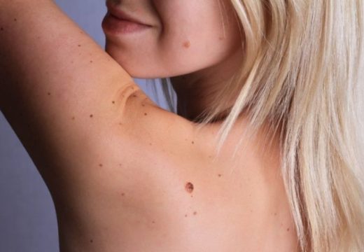 Mogu se pojaviti bilo gdje na tijelu: Kako razlikovati opasne od bezopasnih mladeža