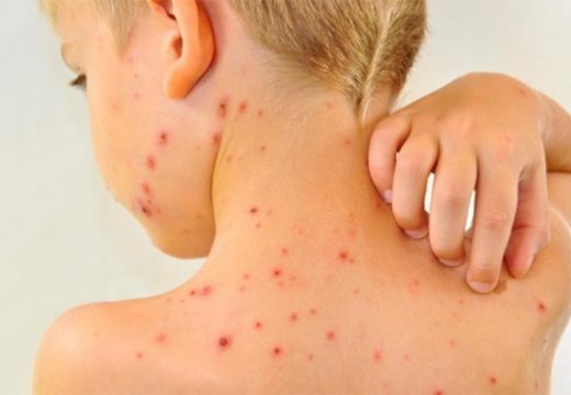 Najviše zaraženih u Bijeljini: Morbilama u Srpskoj zaraženo 38 osoba
