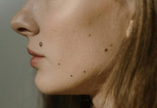 Šta znači kad mladež svrbi: Stručnjak otkriva ko je u većem riziku od raka kože