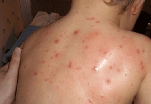 Izdate preporuke građanima: Prvi slučajevi malih boginja u Doboju