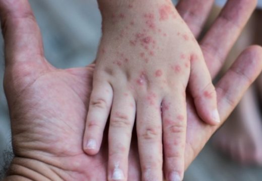 Najviše u Bijeljini: U Srpskoj morbilima zaraženo 184 lica