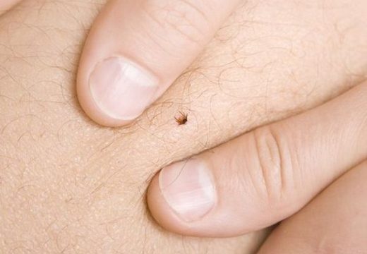 Bez čupanja i bola: Evo kako na najlakši način da izvadite krpelja (Video)