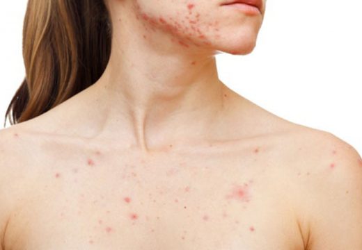 Institut za javno zdravstvo Srpske: U Srpskoj raste broj zaraženih morbilama