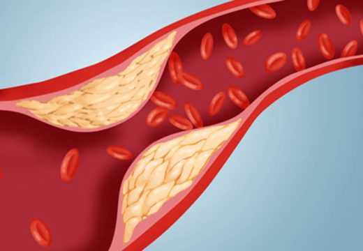 Imate loš holesterol: Ovaj napitak olakšaće vam život