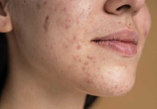 Zdravstveni problemi: Promjene na licu mogu ukazivati na visok šećer u krvi