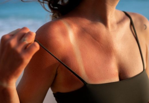 Zdravlje: Pet namirnica koje pomažu vašem tijelu da se oporavi od opekotina od sunca