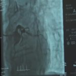 Istorijski zahvat u Doboju: Prva operacija tumora na mozgu