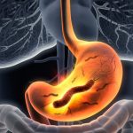 Rani simptomi koje zanemarujemo: Rak želuca krije se iza tegoba sa varenjem