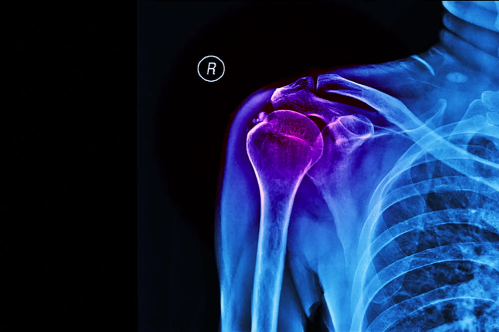 Шта је калцификација и зашто је опасна: Страдају артерије, бубрези…