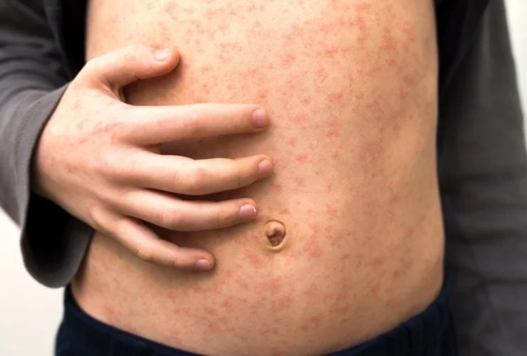 Morbillo negli Usa: più di 160 casi, cresce la paura contagio!