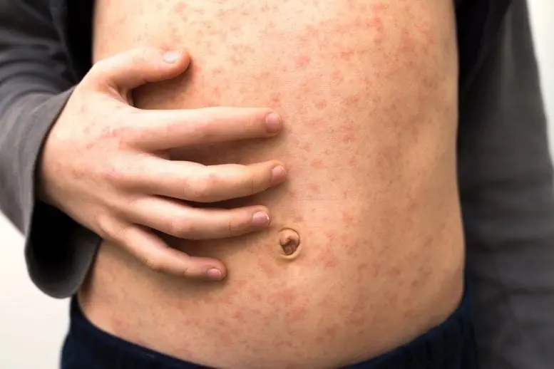Morbillo negli Usa: più di 160 casi, cresce la paura contagio!