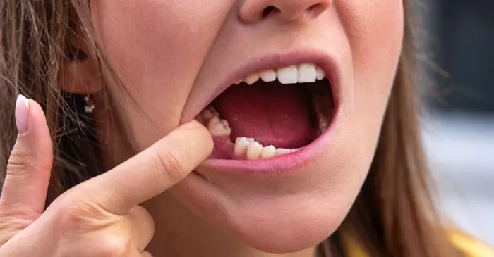 Scienziati britannici crescono denti umani in laboratorio come alternativa agli impianti