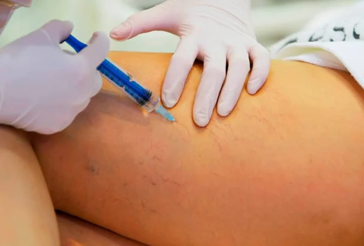Fleboterapia trap o metodi classici: quale cura garantisce risultati migliori?