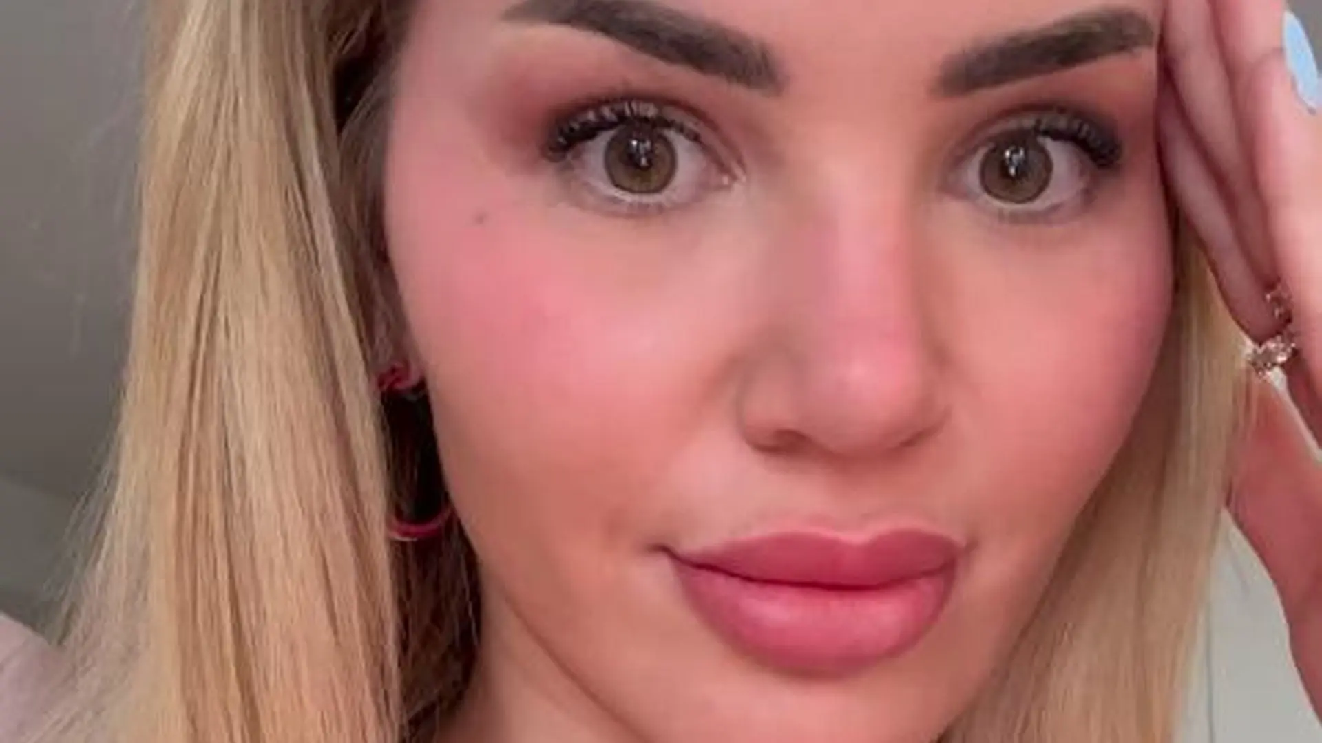Kim Virginia Hartung racconta la sua battaglia contro l’acne in gravidanza