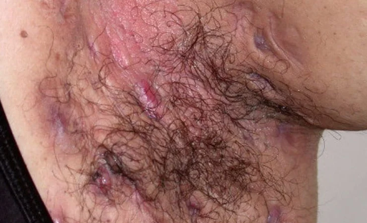 Secukinumab riduce il dolore cronico nell’hidradenite suppurativa