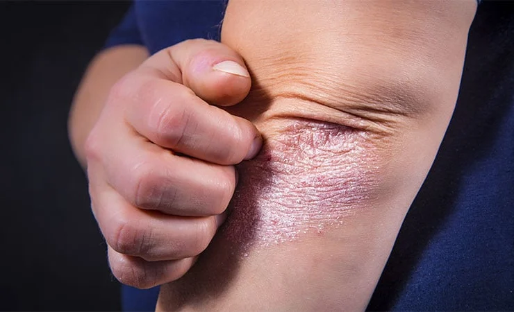 Gli inibitori di IL-23 garantiscono la migliore sopravvivenza terapeutica nella psoriasi