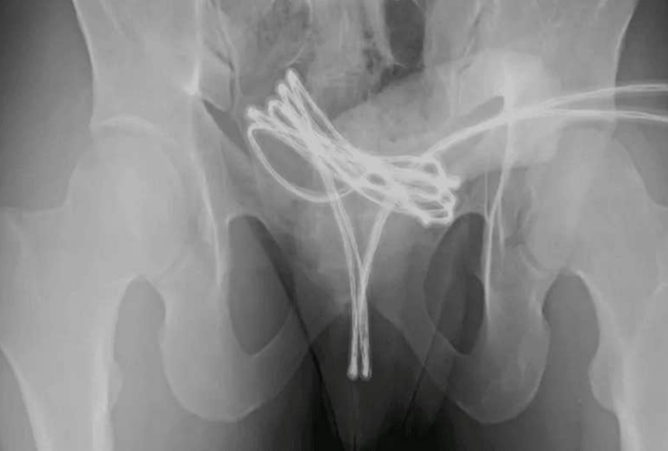 Scoperta inquietante nel corpo di un giovane di 21 anni