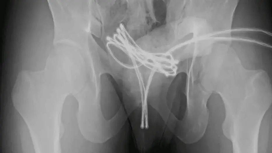 Scoperta inquietante nel corpo di un giovane di 21 anni